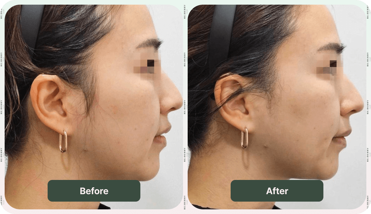 before and after face lift treatment