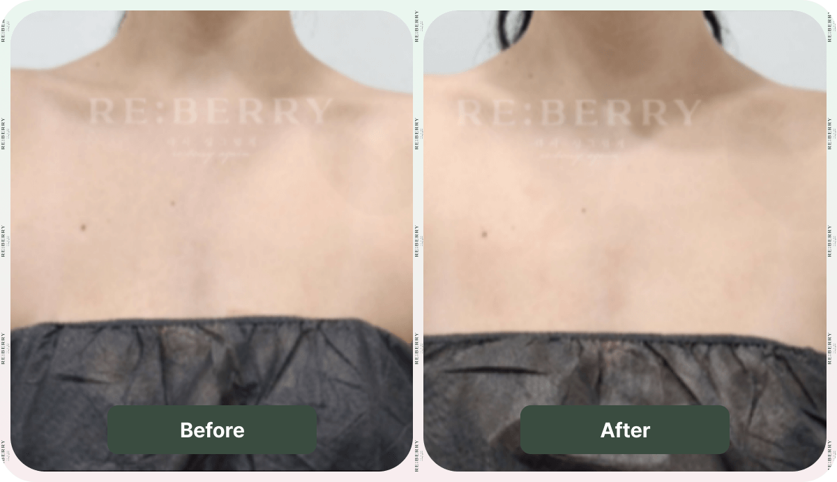 before after body treatments