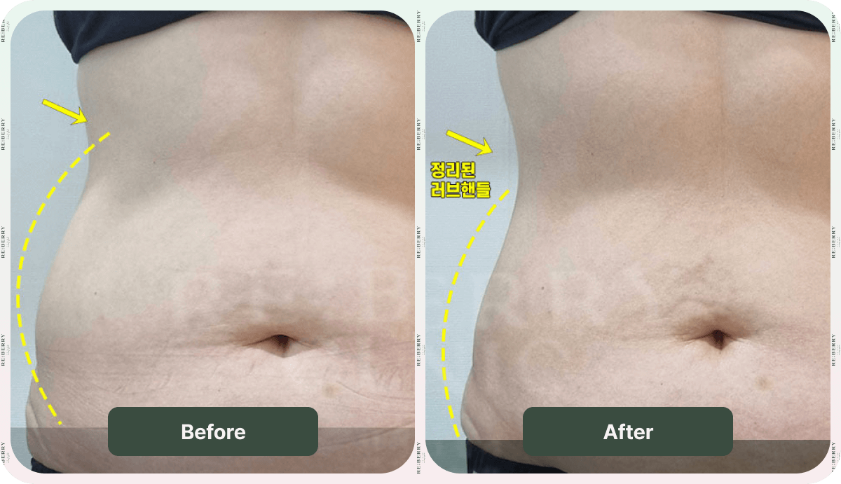 before after body treatment