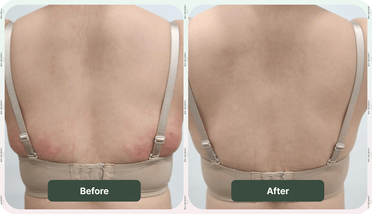 before after body treatments