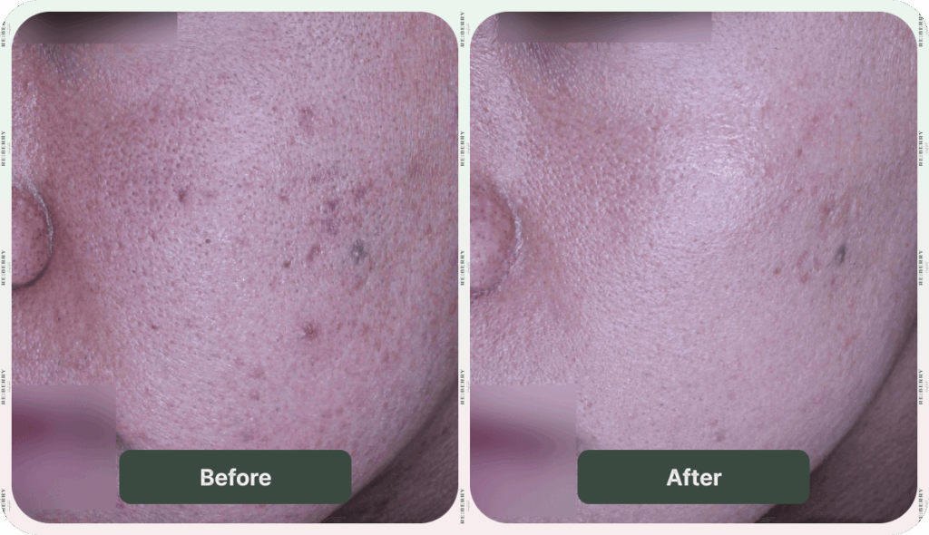 before and after acne treatment
