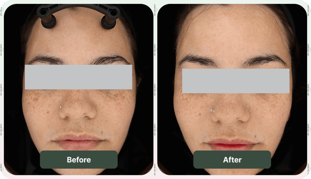 before and after acne treatment