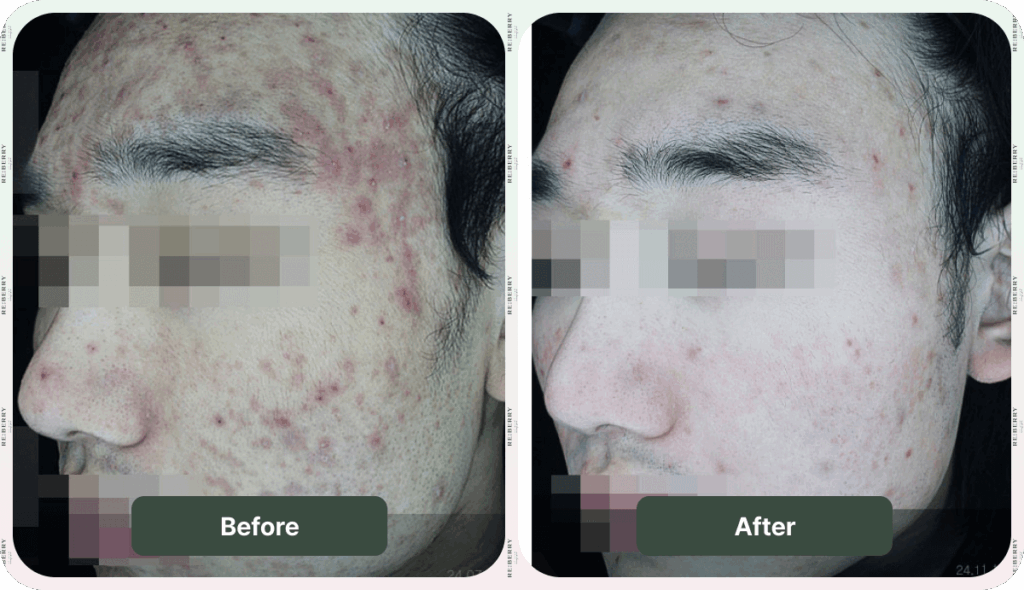 acne treatment before and after