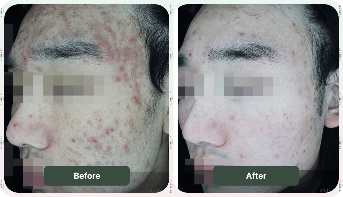acne treatment before and after