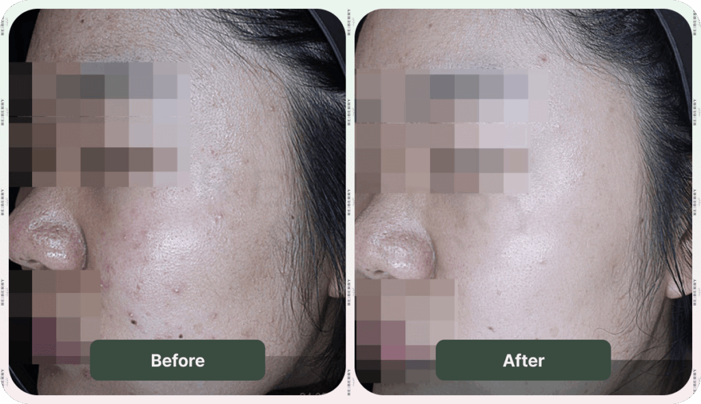 before and after acne treatment