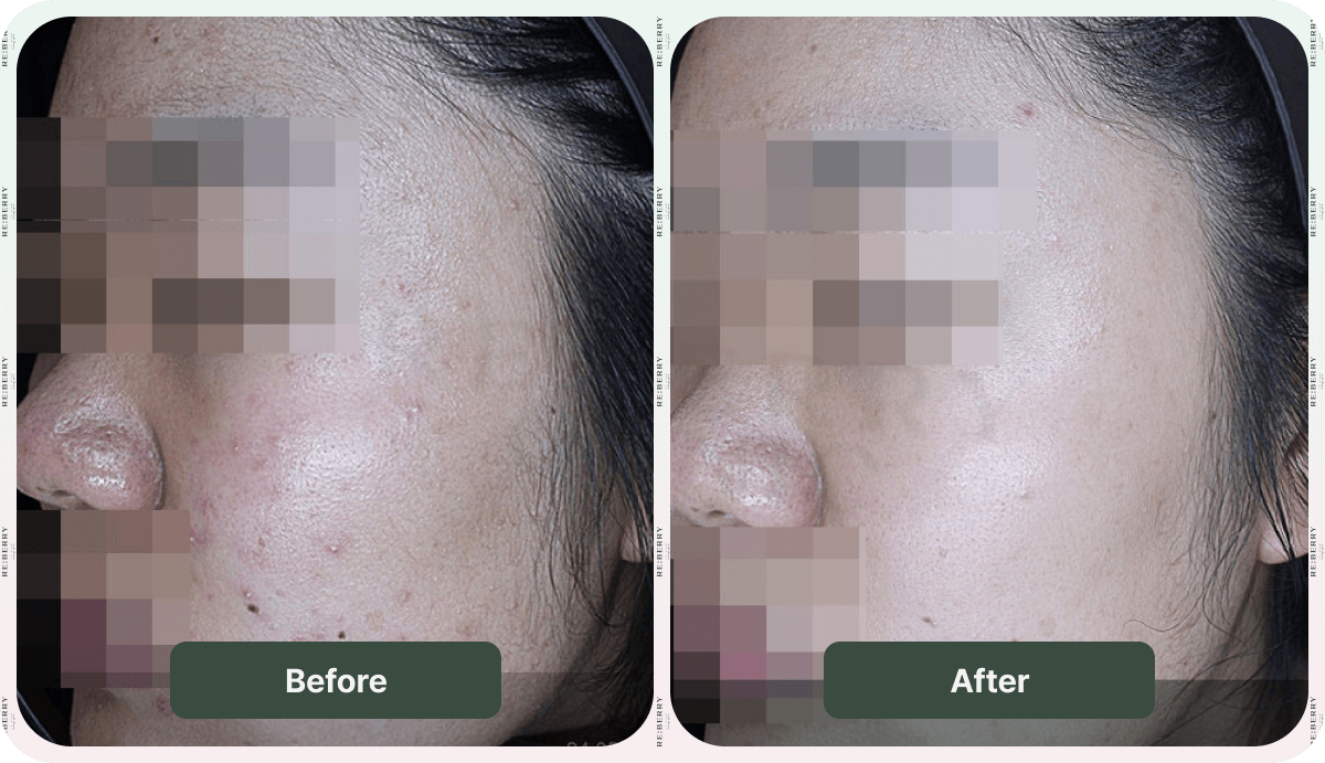 before and after acne treatment