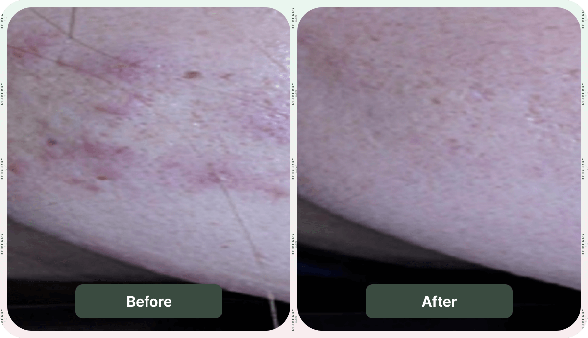 acne treatment before and after comparison