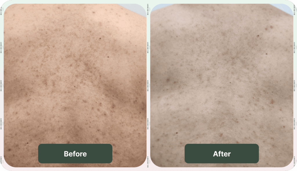 before and after acne treatment