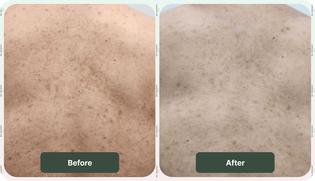 before and after acne treatment