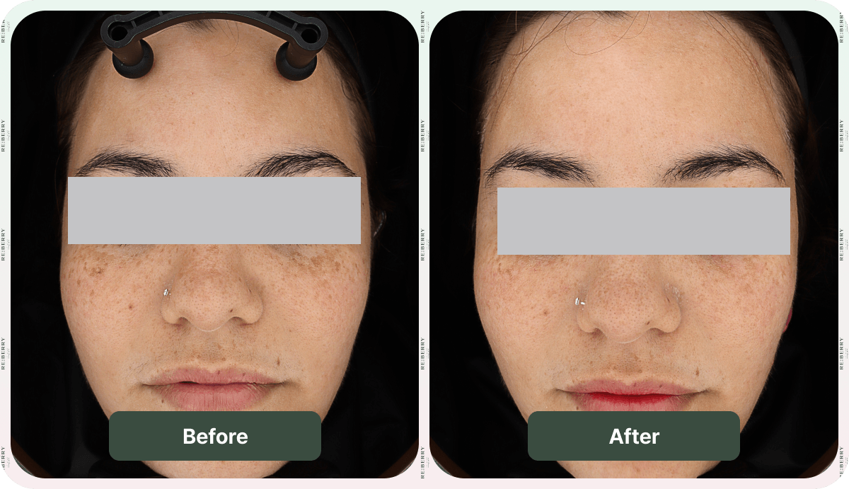before and after acne treatment