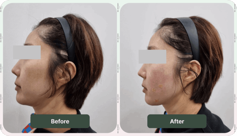 Stem Cell Before & After [Simplified Chinese] - Reberry