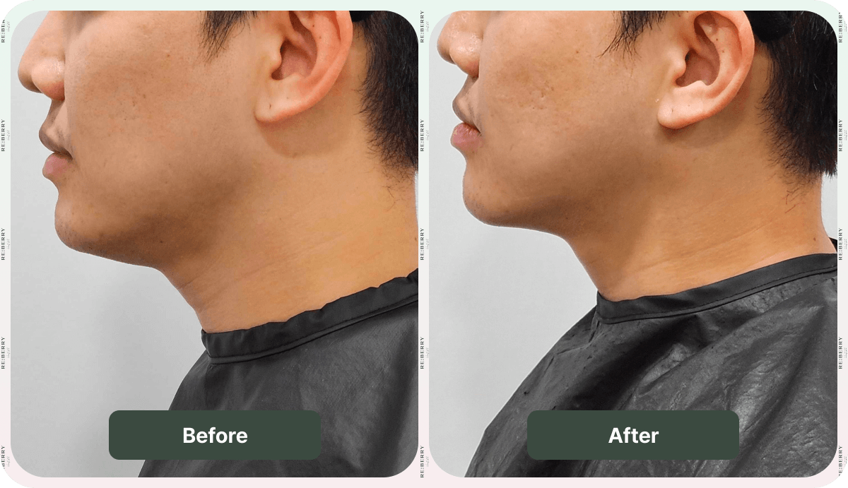before after revinas men