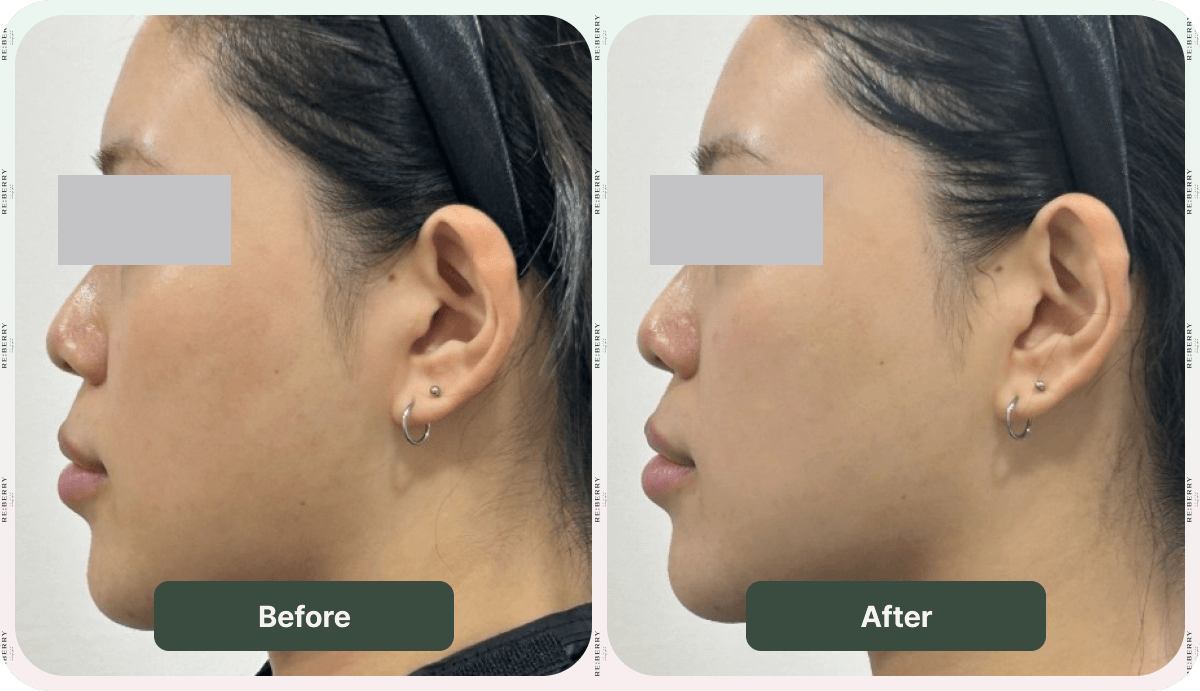 before after revinas image