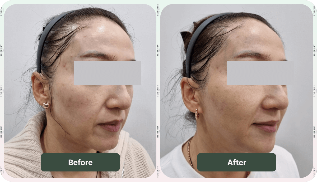 before after revinas