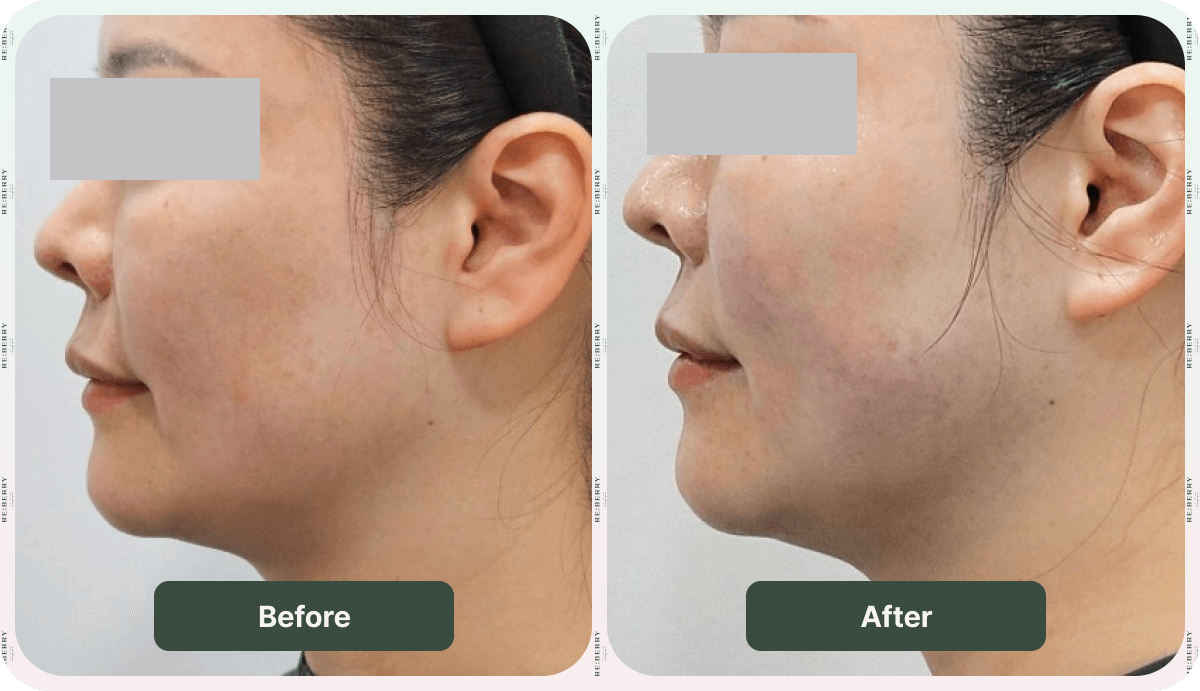 before and after sofwave