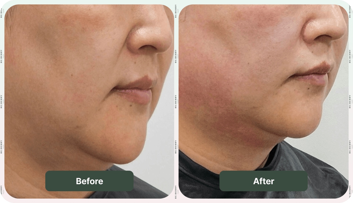 sofwave before after