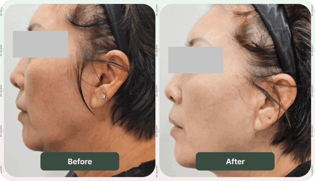 before and after face lift sofwave