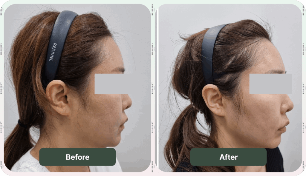 facelift before after