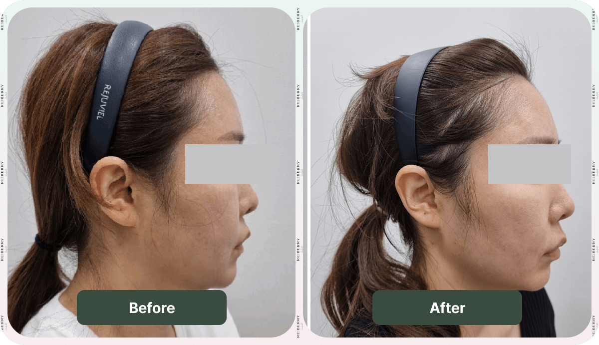 facelift before after