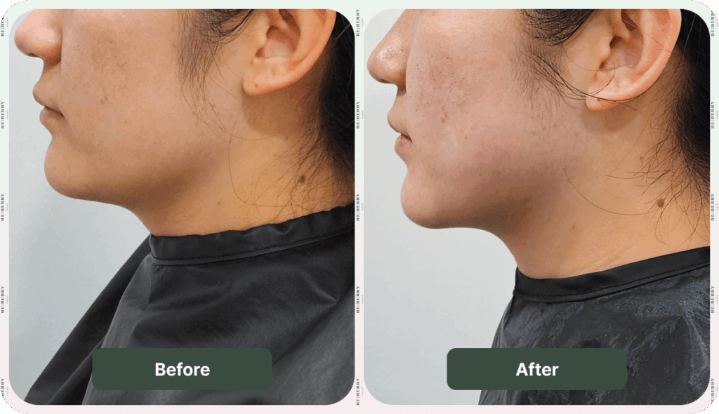 before and after ultherapy
