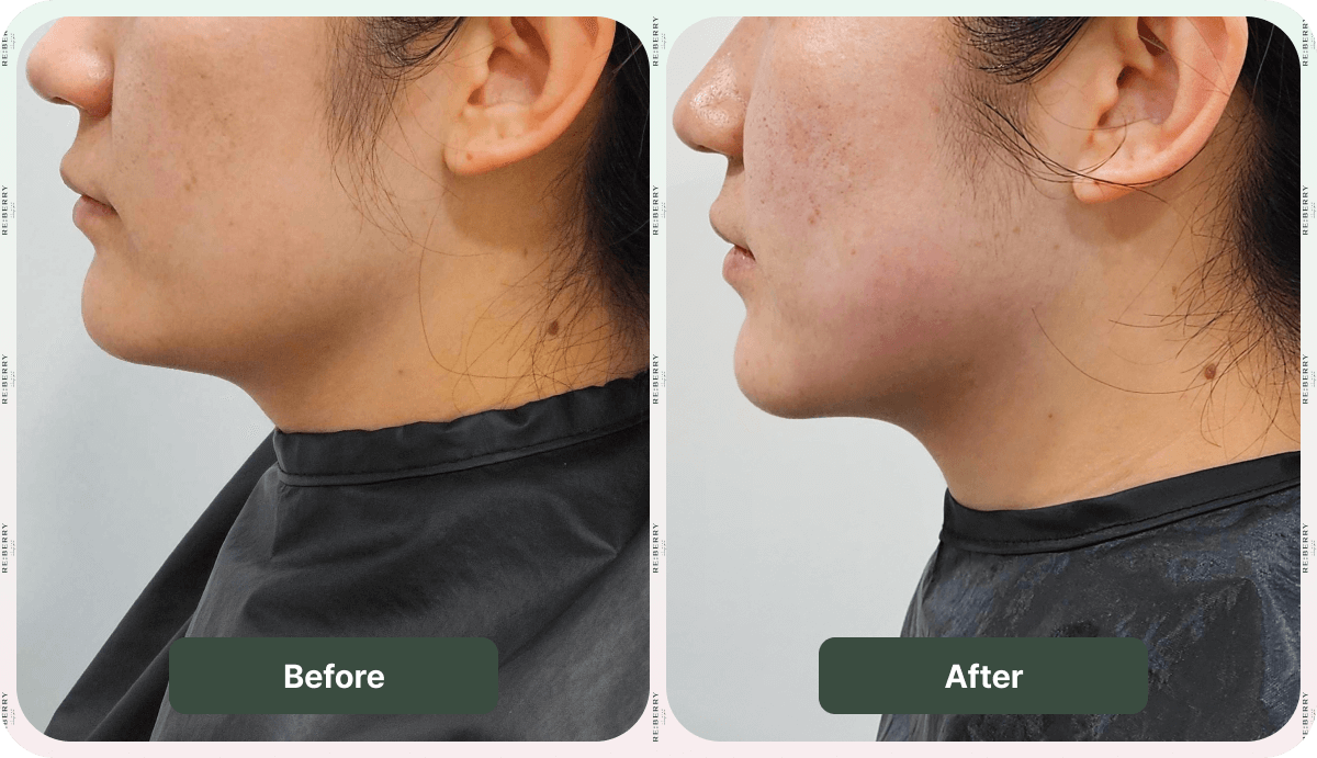 before and after ultherapy