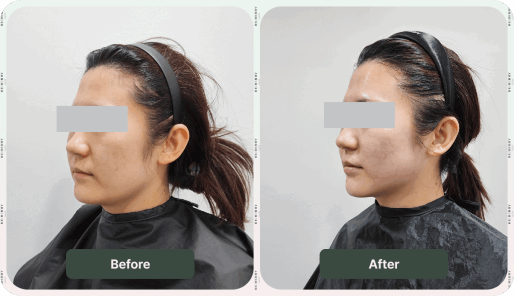 face lift ultherapy before and after face lift