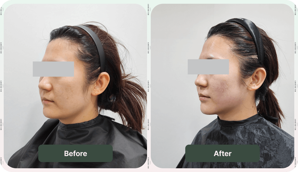 face lift ultherapy before and after face lift