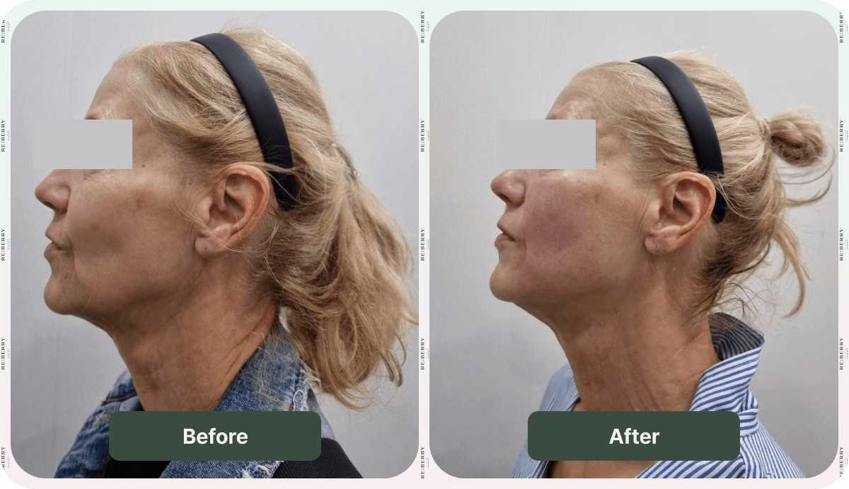 face lift before and after