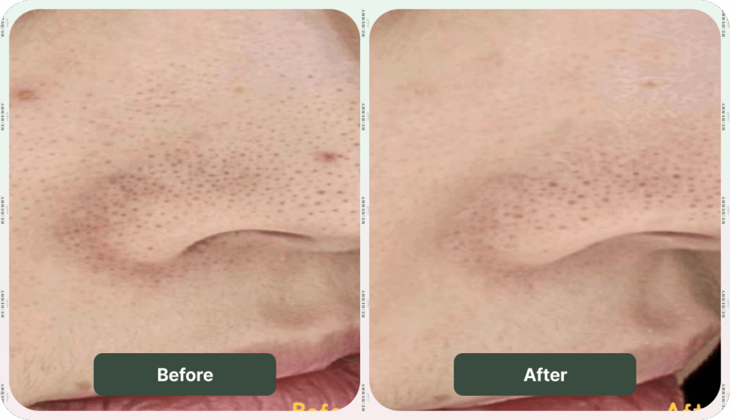 before and after injection