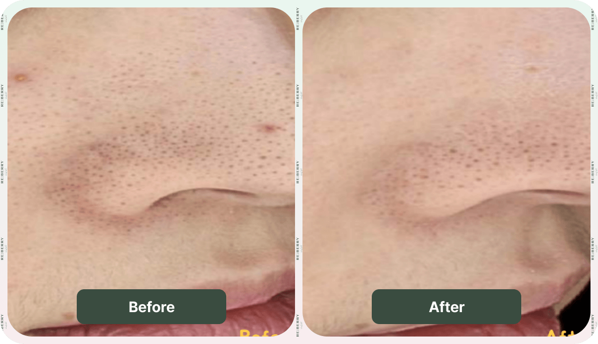 before and after injection