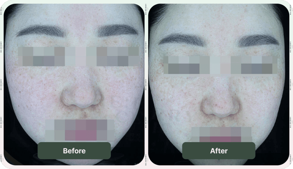 before and after injection