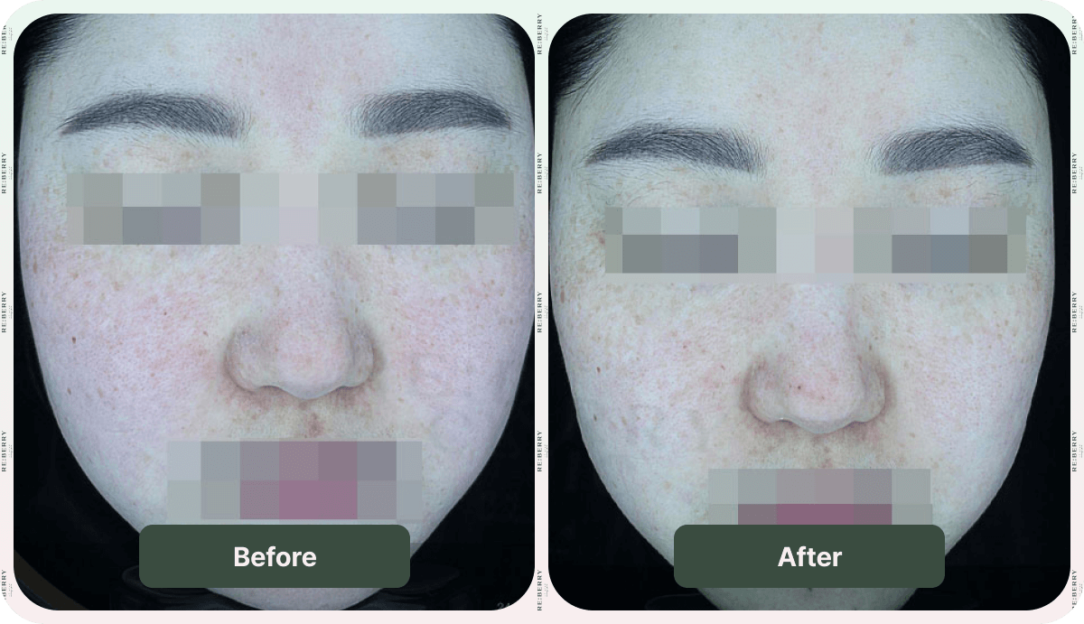 before and after injection