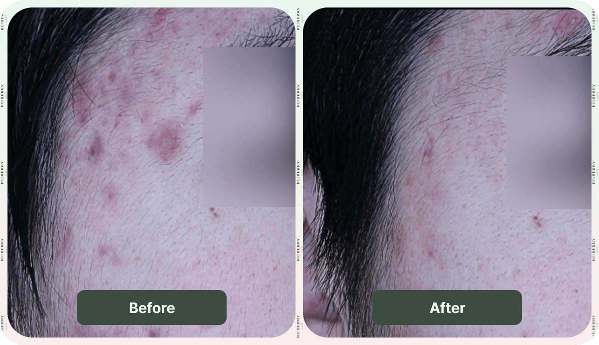 before and after juvelook