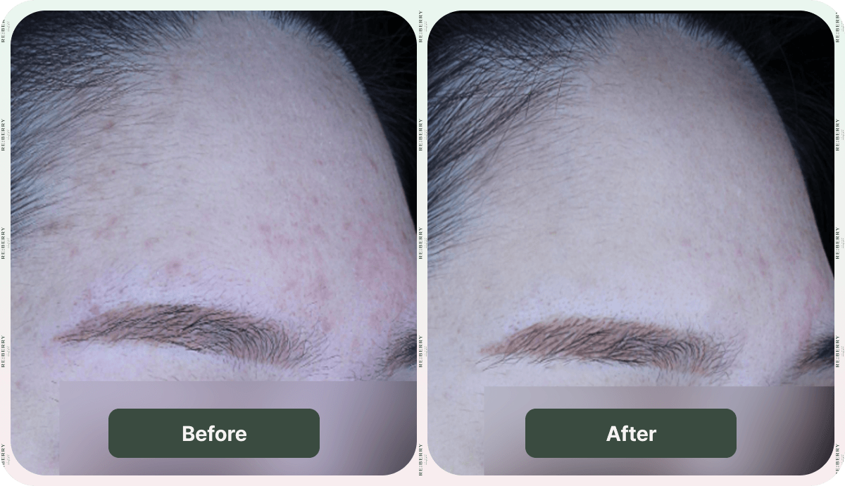 before and after injection treatment juvelook