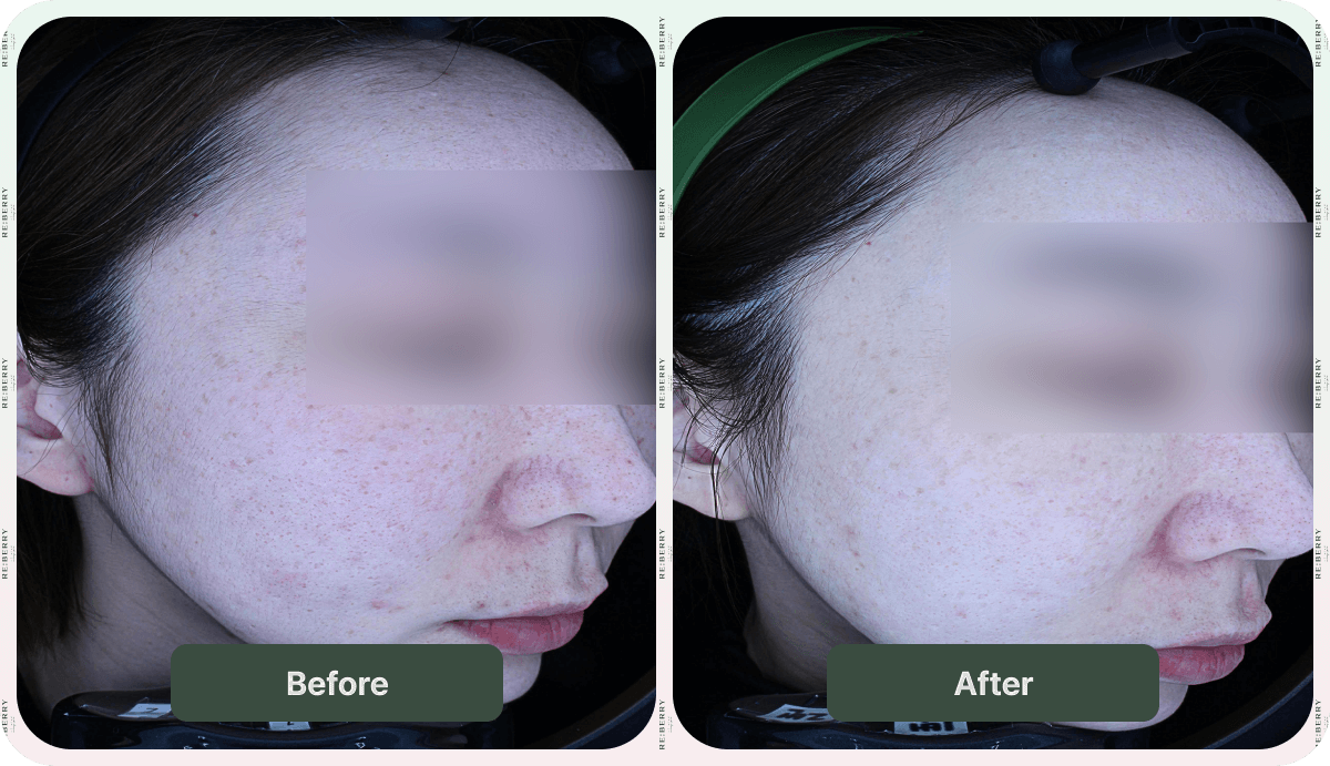 before and after injection treatment