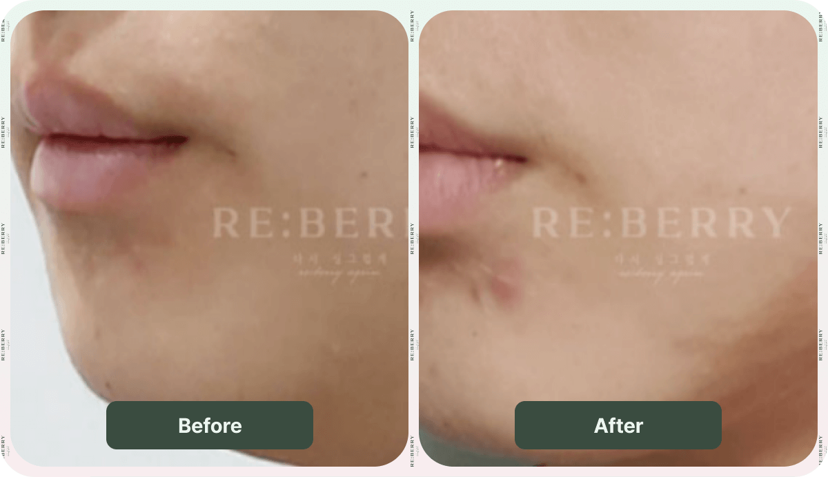 before and after slimcut injection