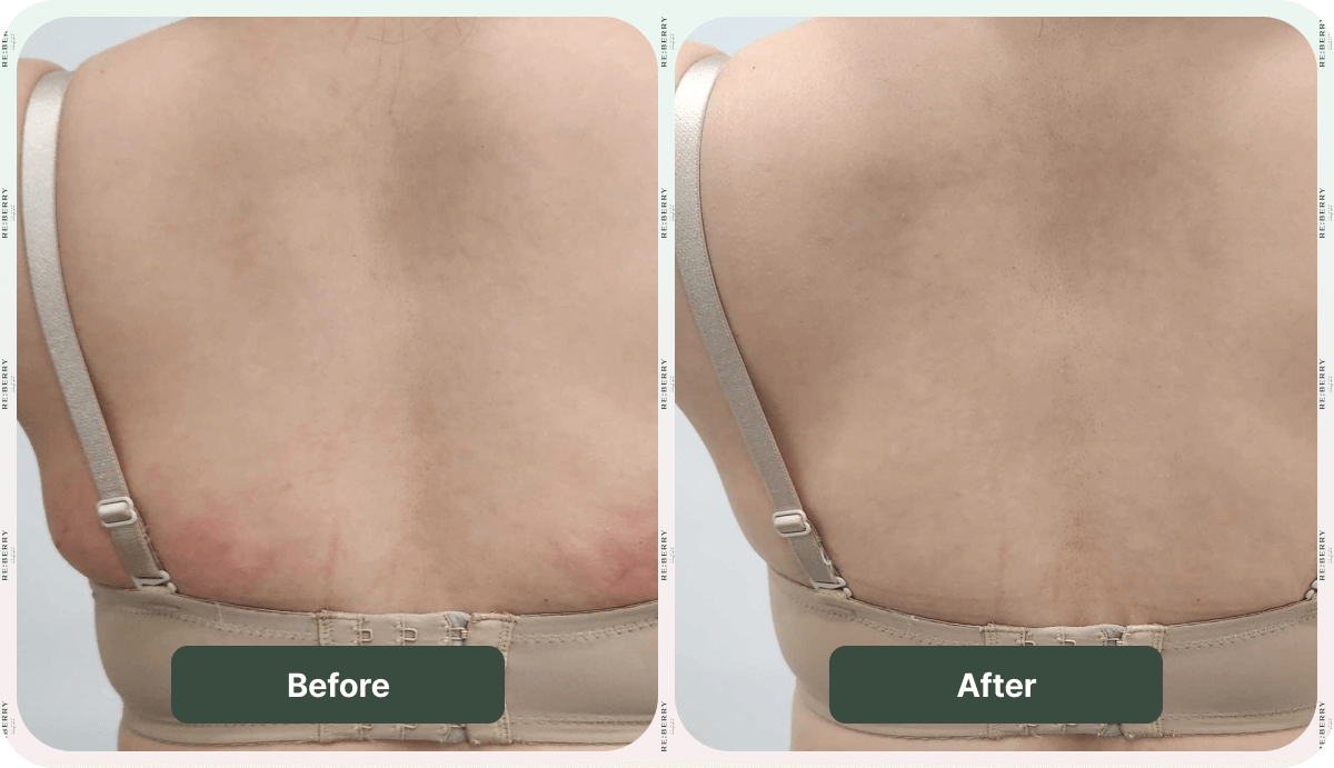 before and after slimcut injection
