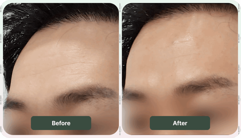 before after body botox treatment image