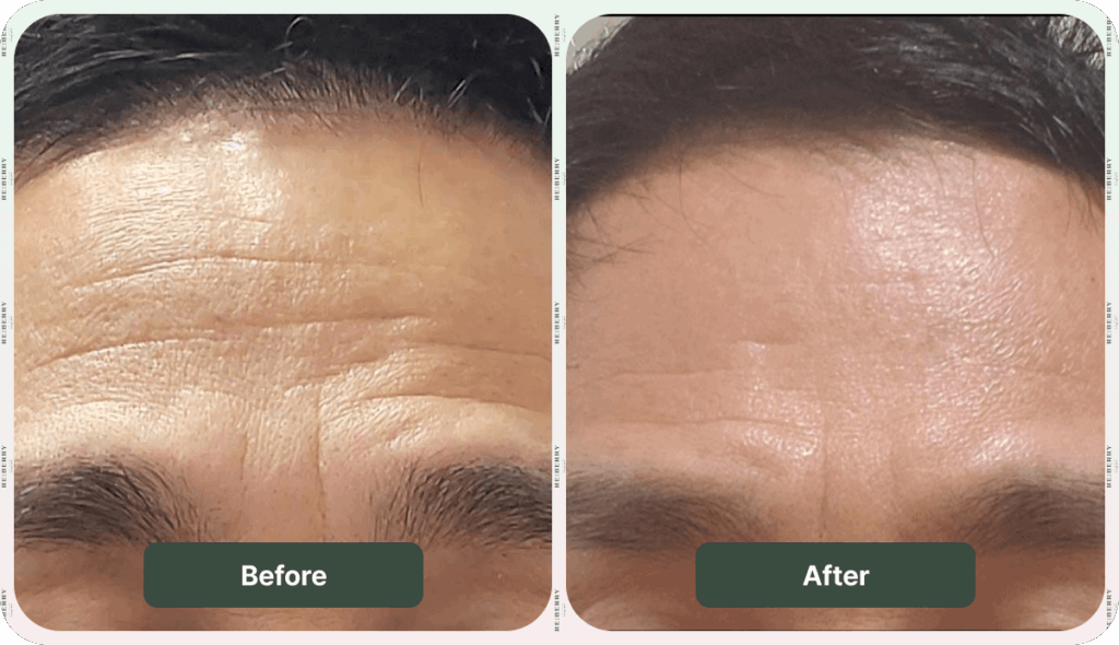 before and after botox treatment