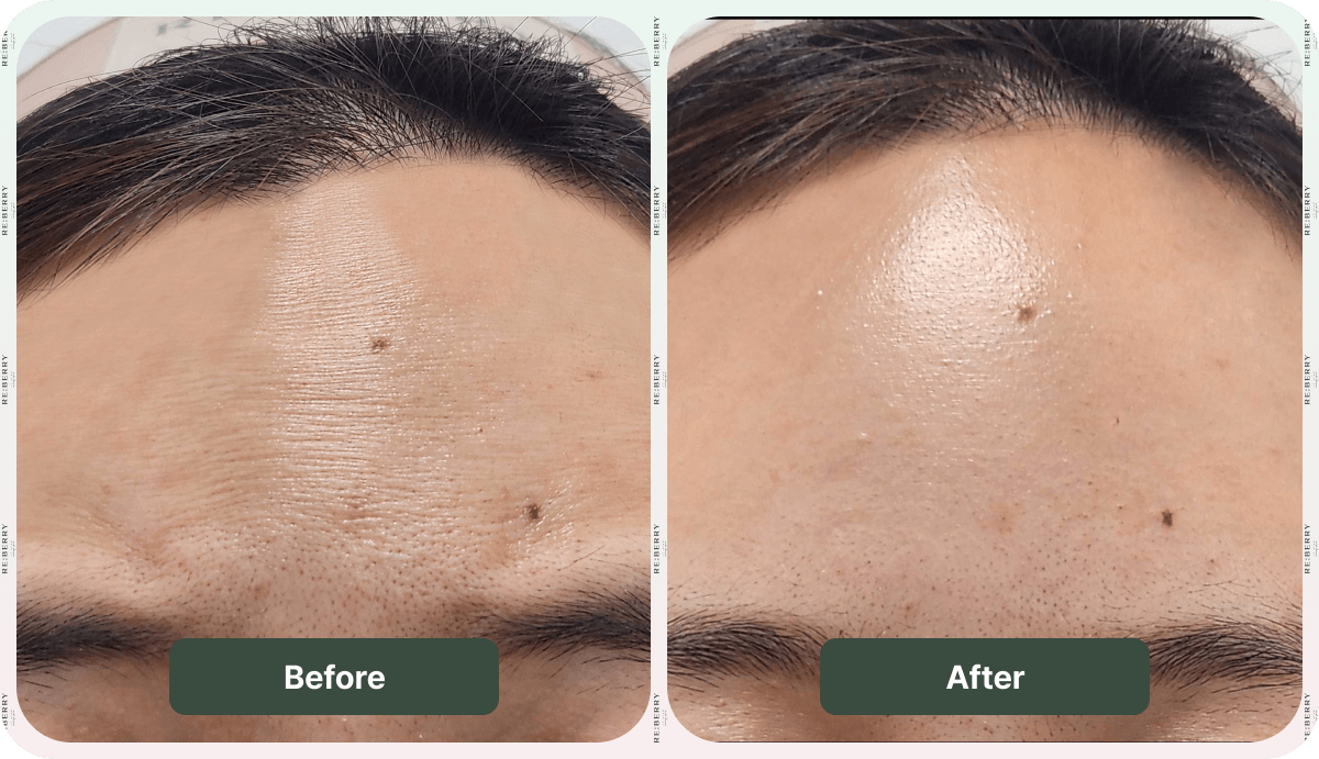 before and after botox