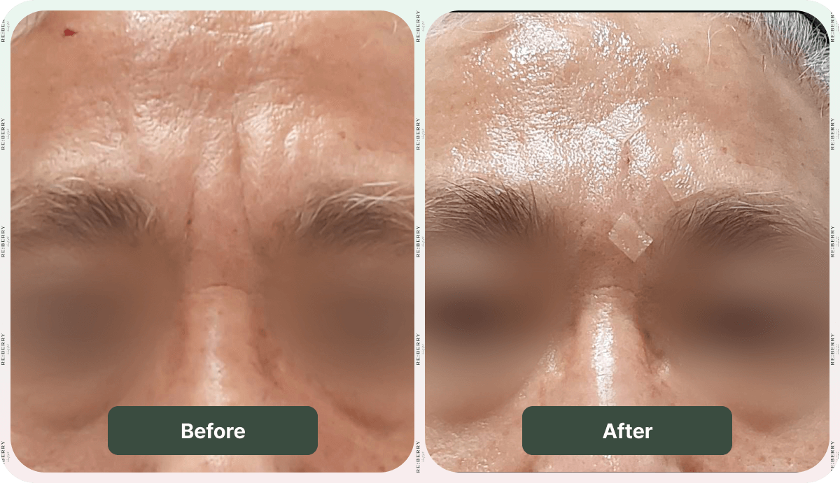 before after botox