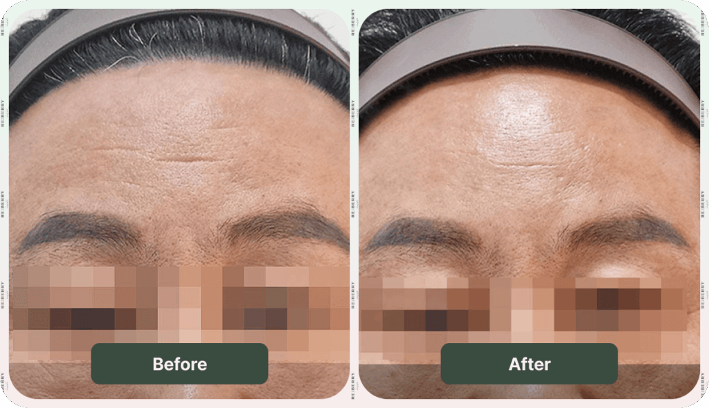 before and after botox image