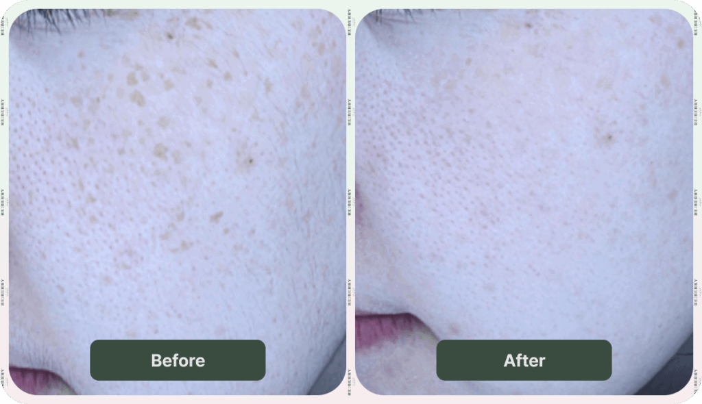 before and after dark spot removal