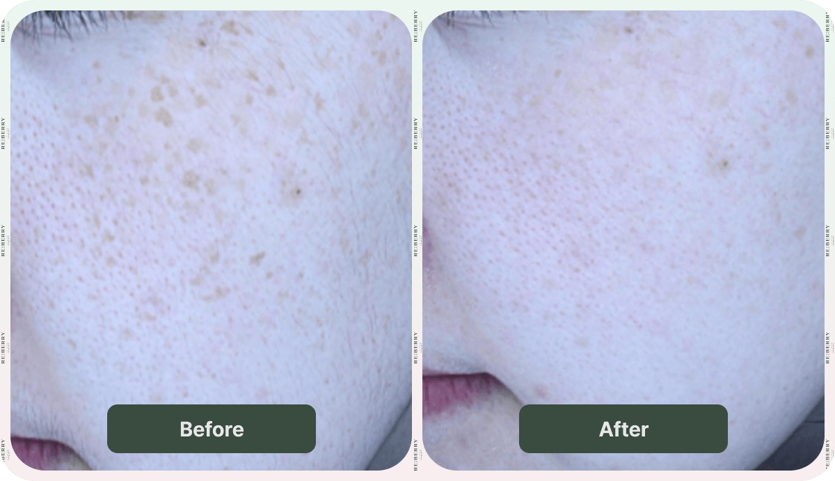 before and after dark spot removal
