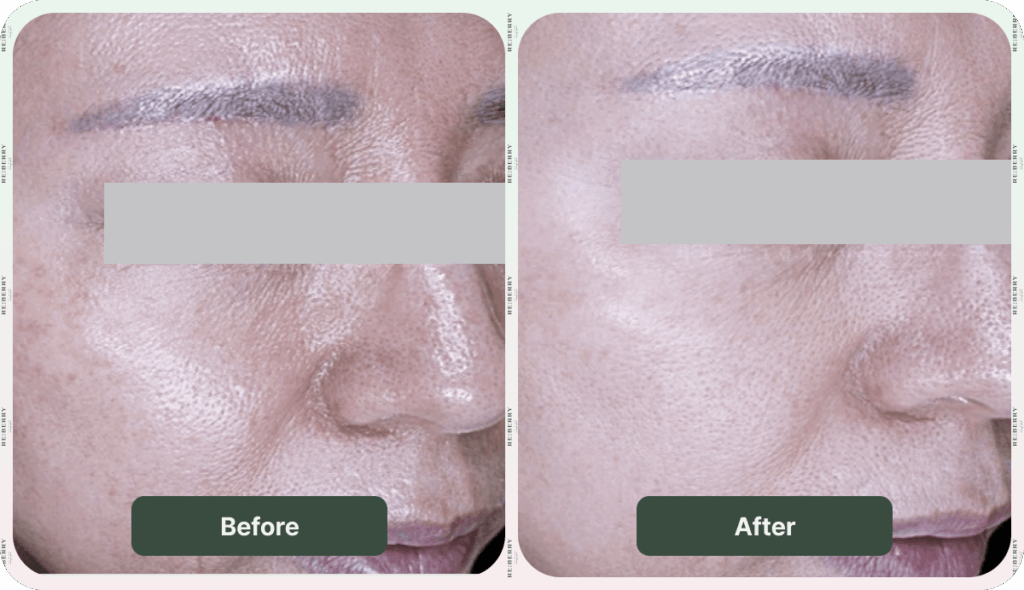 before and after dark spot removal
