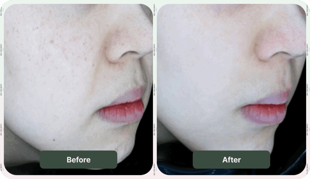 before and after dark spot removal