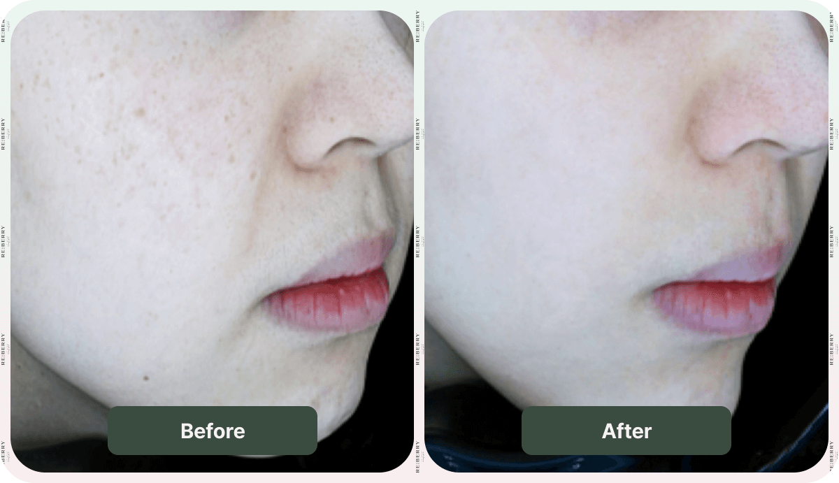 before and after dark spot removal