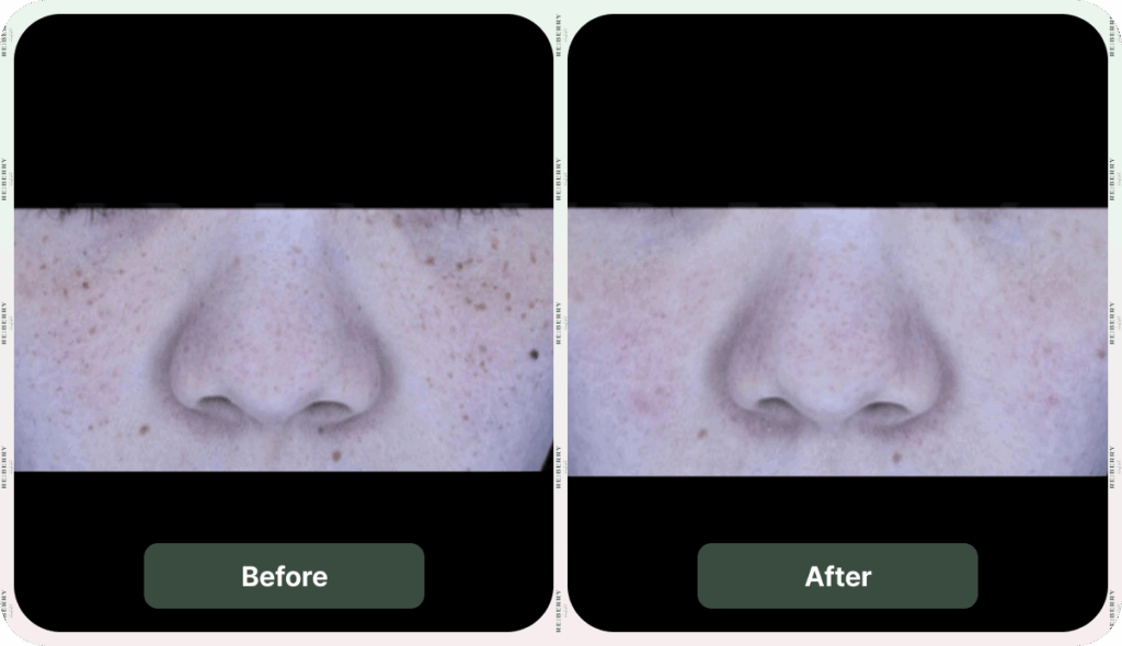 before and after dark spot removal