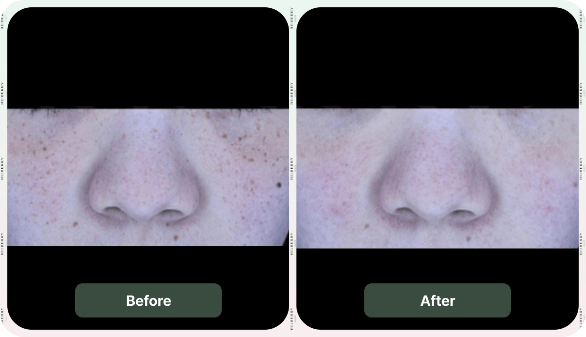 before and after dark spot removal