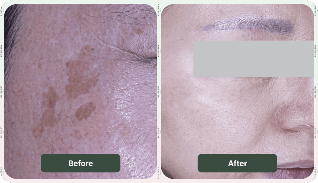 before and after dark spot removal